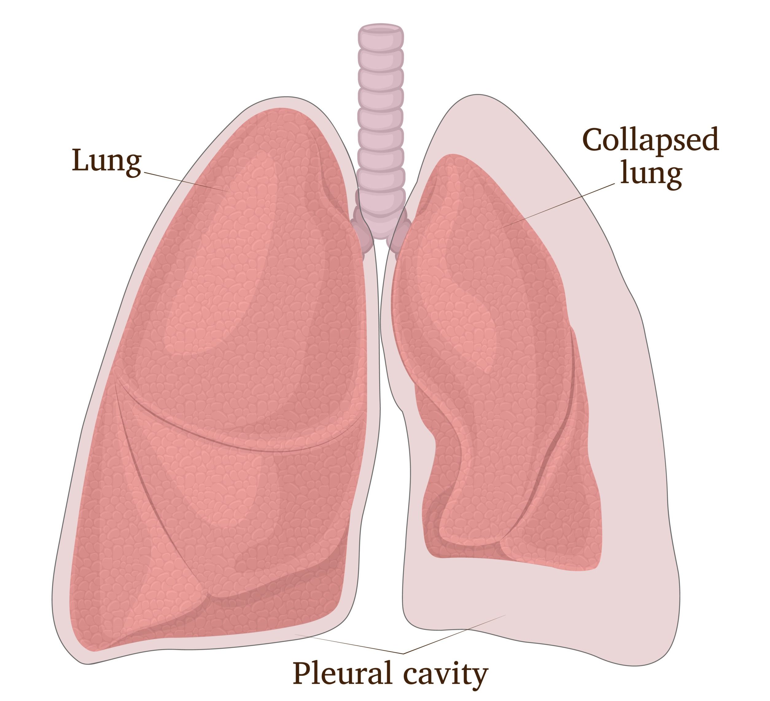 figure comparing inflated lung and collapsed lung due to pneumothorax