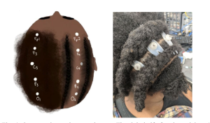 Image depicting the cornrow braiding technique and the Sevo electrodes