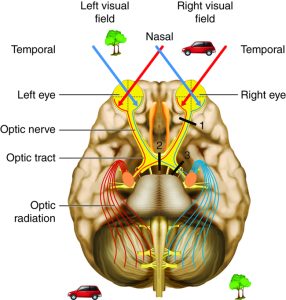 Diagram of the visual pathway showing left/right visual fields, retinal projections, optic chiasm crossing, and labeled optic nerve, tract, and radiations. (Image Description available)